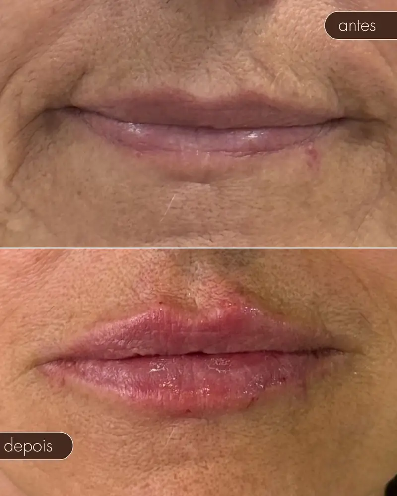 Antes e depois — Preenchimento labial